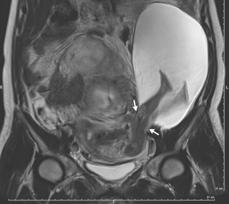 Image: NEJM, Pierre-Emmanuel Bouet, Centre Hospitalier Universitaire d’Angers, Angers, France